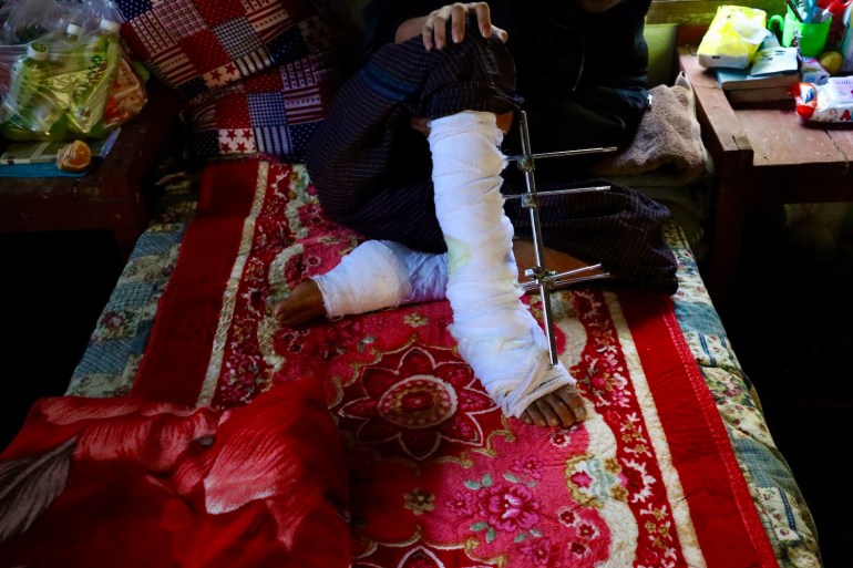 Un combatiente antigolpista muestra sus piernas vendadas debido a una herida provocada por una mina terrestre